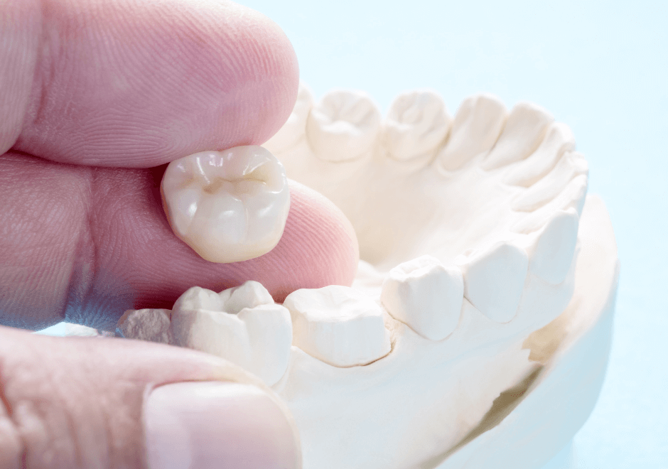 Dental crowns model - Crescent Lodge Dental Practice - Clapham, London