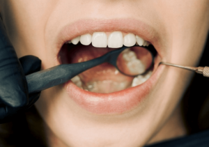 Woman with white fillings at Crescent Lodge Dental Practice in Clapham