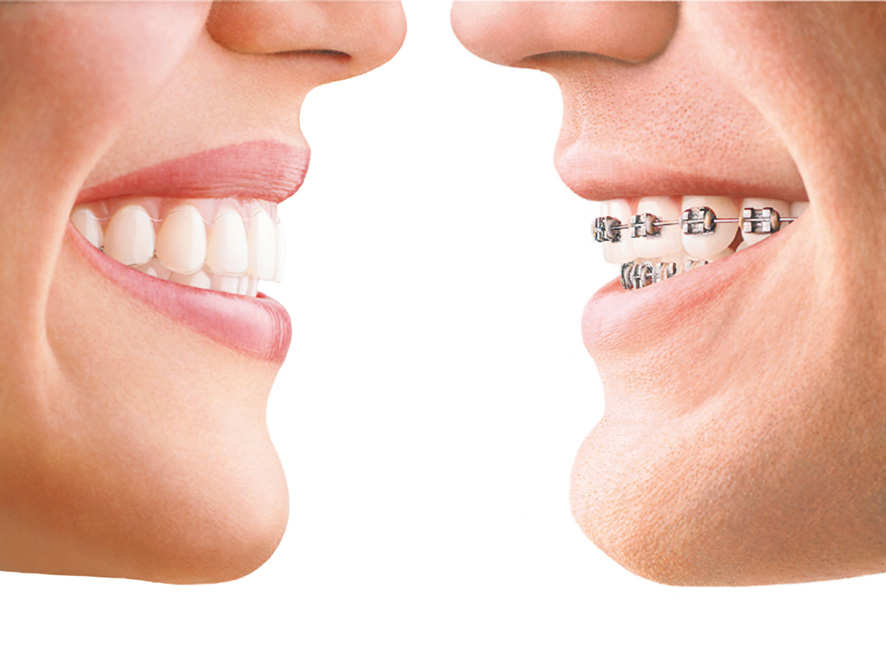 Orthodontic braces at South West London | Crescent Lodge Dental Practice