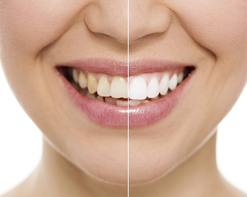 Woman with teeth whitening at Crescent Lodge Dental Practice in Clapham