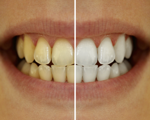 Before and after of at home teeth whitening in Clapham