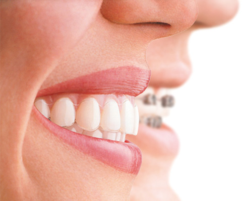 woman with Invisalign orthodontist braces and without braces at Crescent Lodge at Clapham