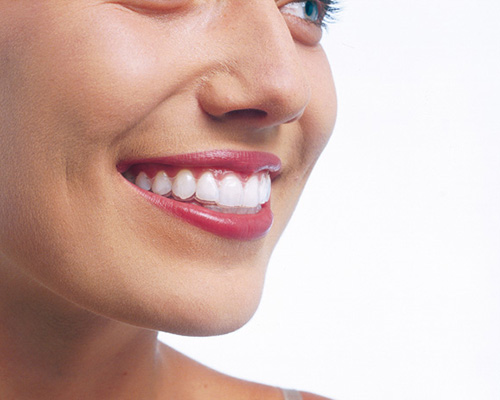 Woman with invisible braces at Clapham dental practice in London