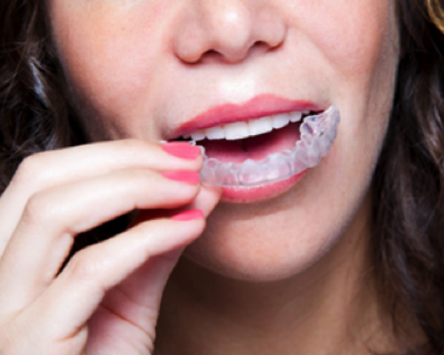 Woman inserting Invisalign Braces, Crescent Lodge in London