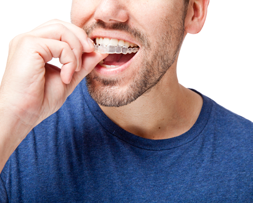 Man with adult braces - Teeth Straightening in Clapham