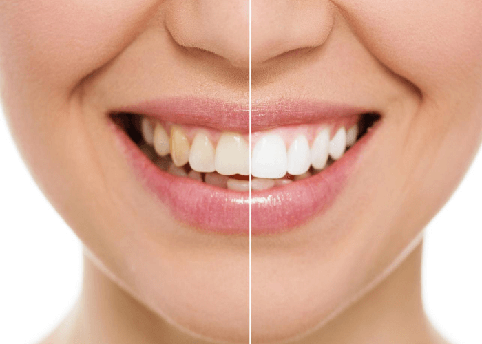 Woman before and after smoking - Oral Hygiene | Dental Practice | Clapham Common