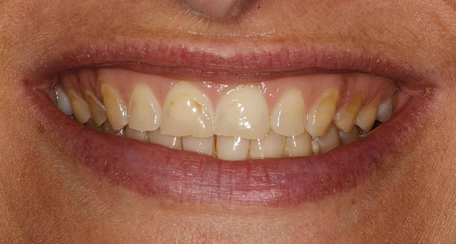 A photo of a persons stained teeth.