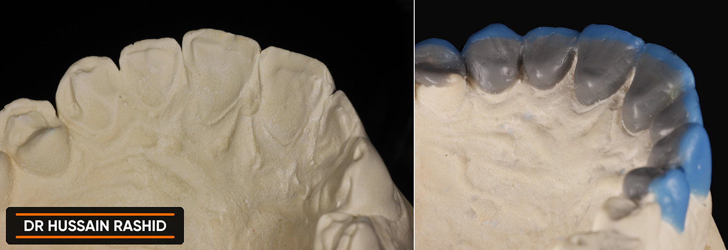 Image of teeth molds