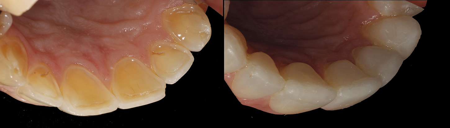 image of teeth before and then after treatment