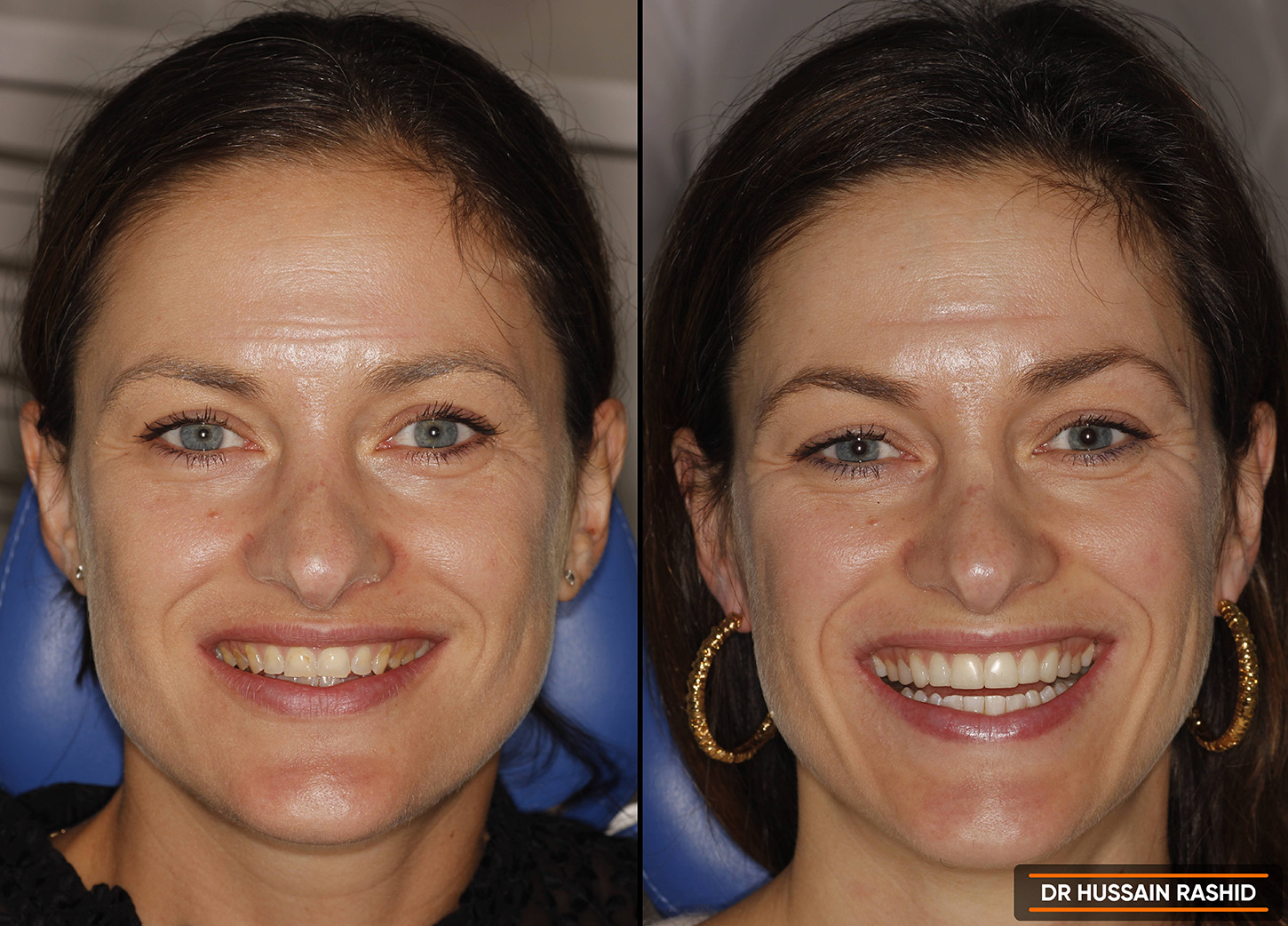 Woman showing her teeth before and after the treatments had been done on her teeth