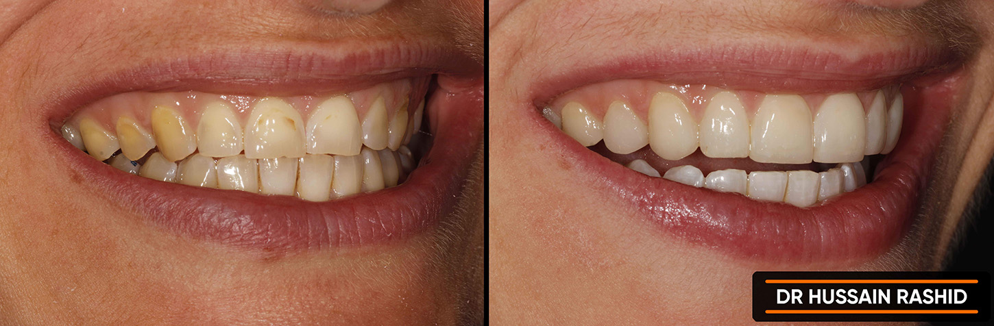 Before and after images of teeth treatment.