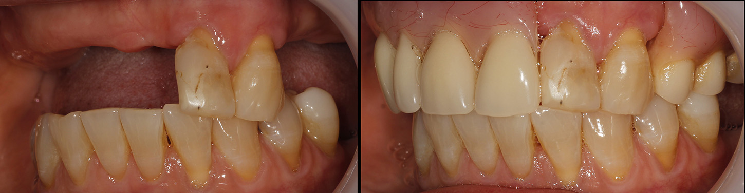 Before and after images of dental implants being fitted.