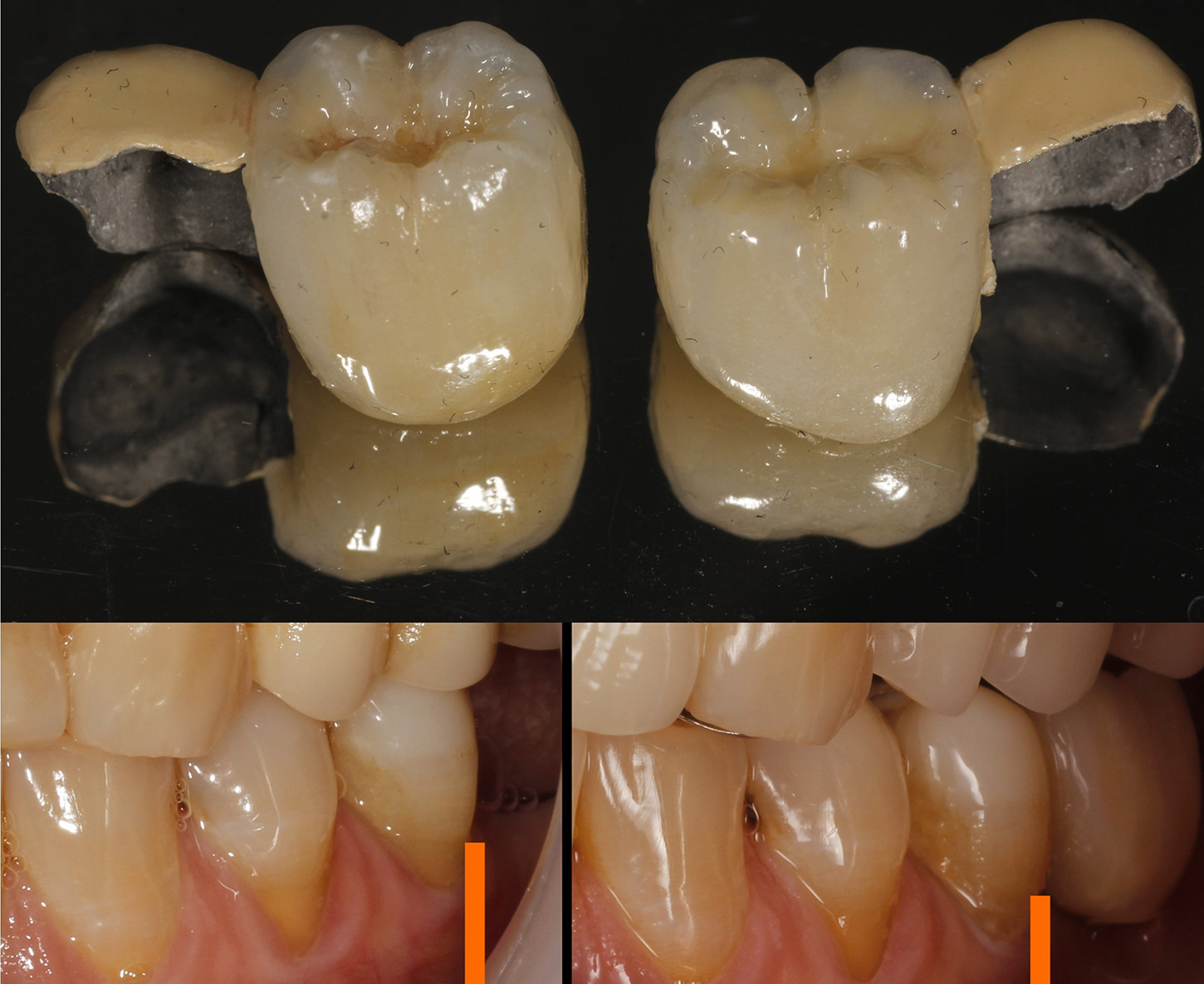 Image of denture that would be put into replace persons teeth