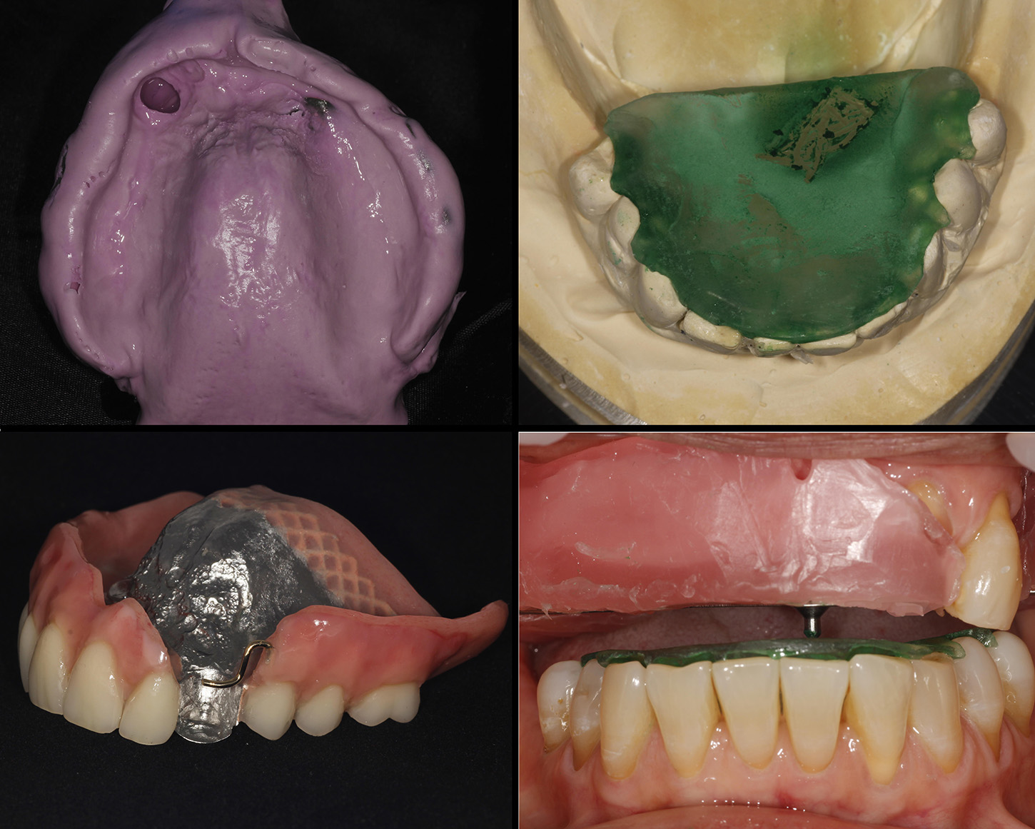 Plastic mould of what the dentures would need to be fitted in.