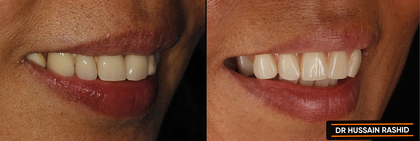 Before and after image of womans teeth.