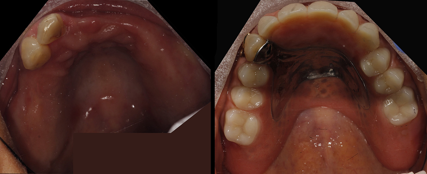 Before and after image of teeth. Pre and post dentures.