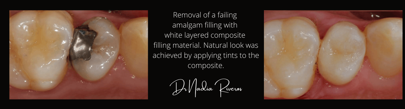 Before and after image of the removal of a filling and filling it with a white layered composite material which gives a natural look.