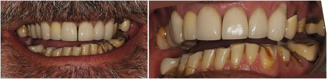 Mans teeth before treatments