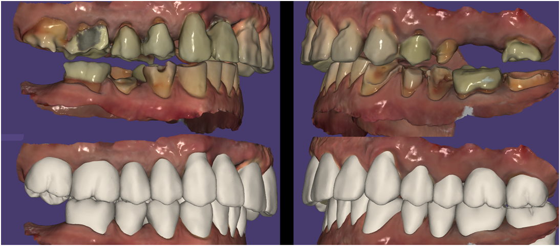 CADCAM of mans teeth before and what they are hoping to achieve in the final result.