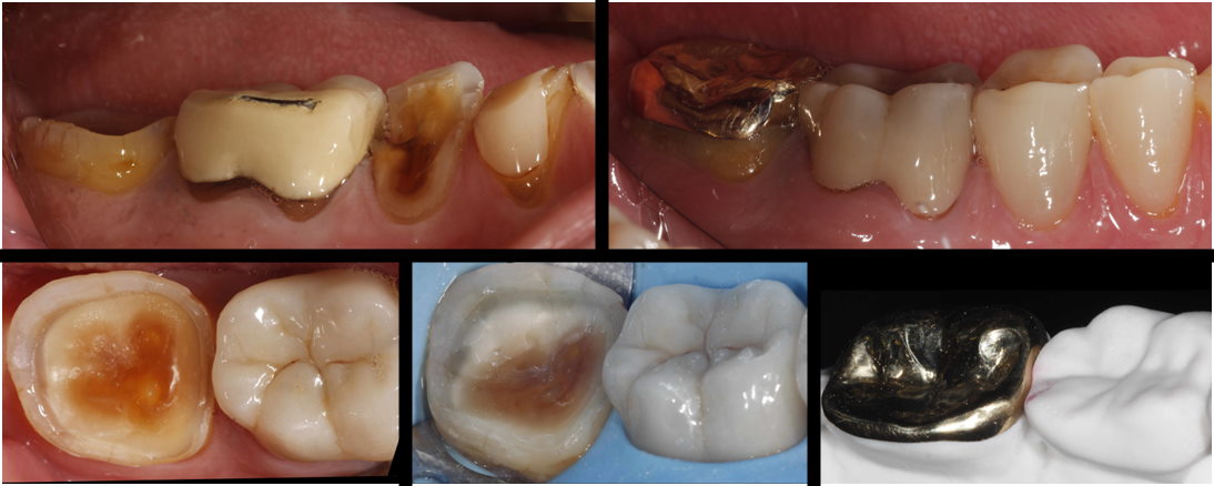 Teeth before treatment.