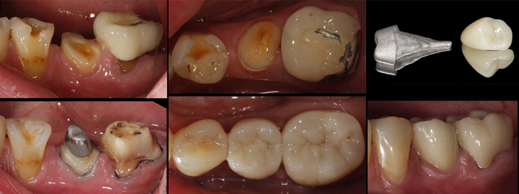 Teeth before treatment.