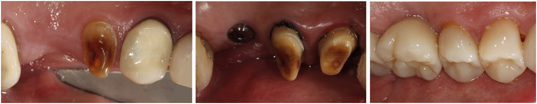 Showing 3 steps of restoring mans teeth.