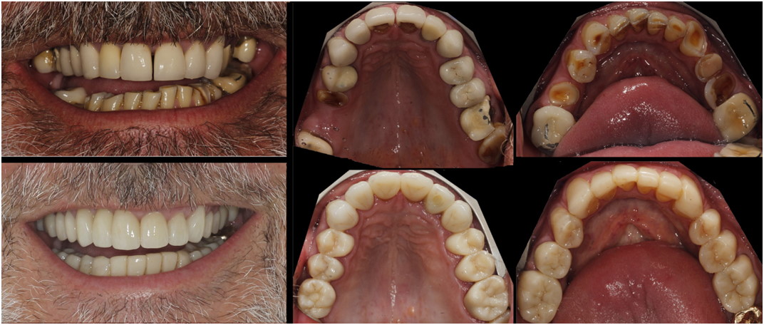 Before and after showing mans teeth.