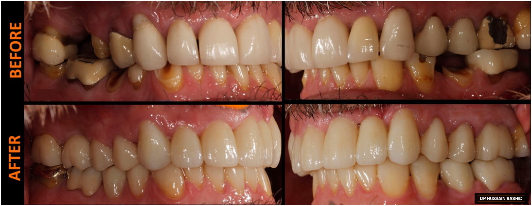 Before and after images of mans teeth before and after treatment.