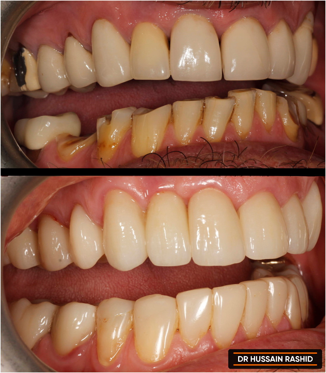 Before and after of mans teeth.