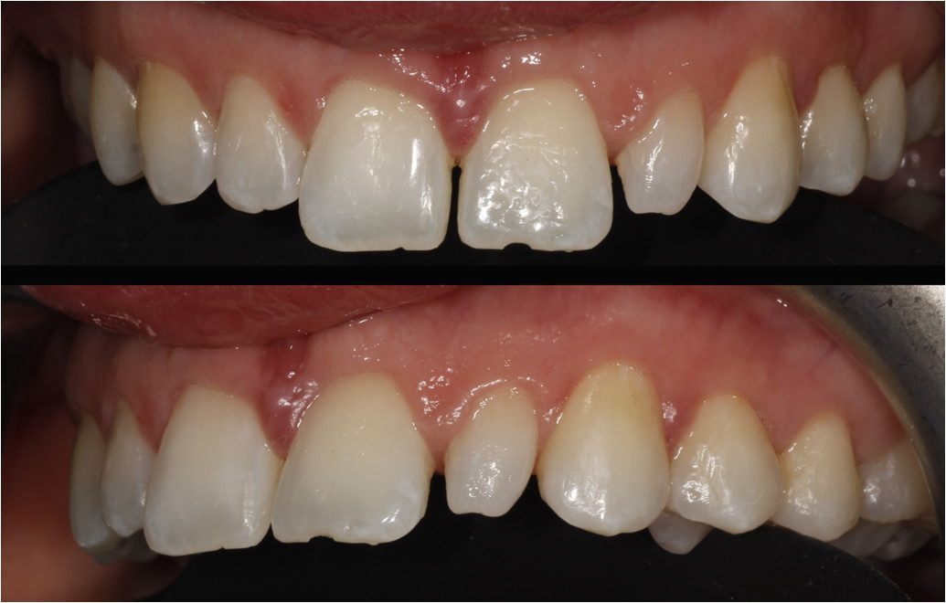 Before image of the top row of teeth.