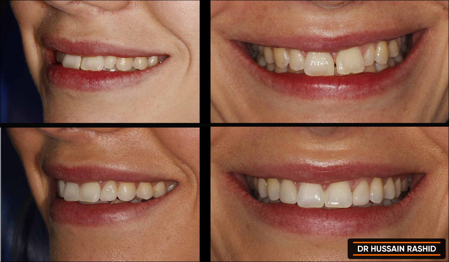 Before and after images of teeth pre and post treatment.