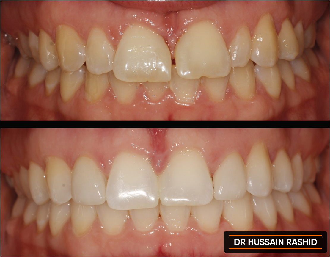 Before and after image of teeth pre and post treatment.