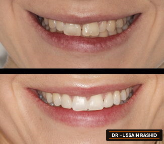 Before and after image of teeth prior and post treatment.