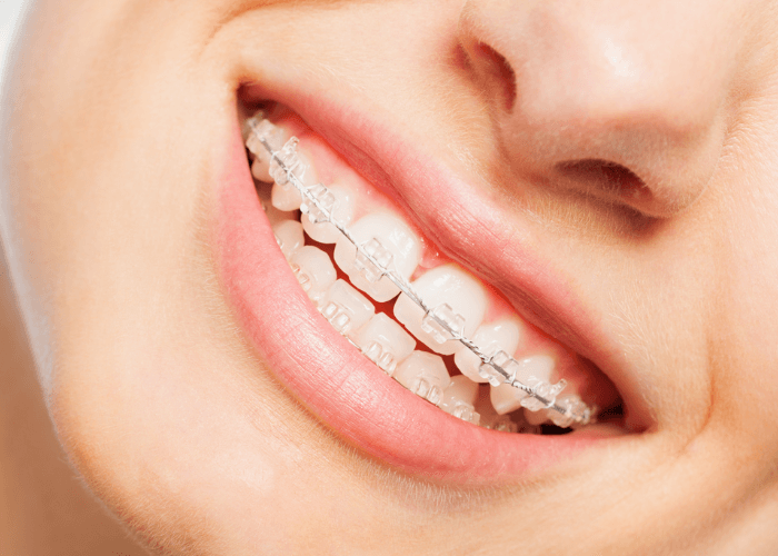 Woman showing her braces from crescent lodge dental