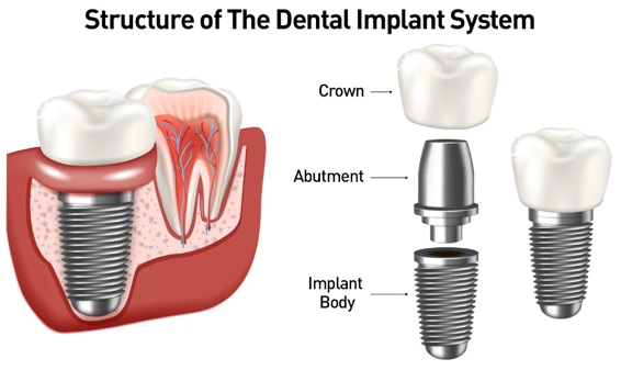 graphic showing the components of a dental implant